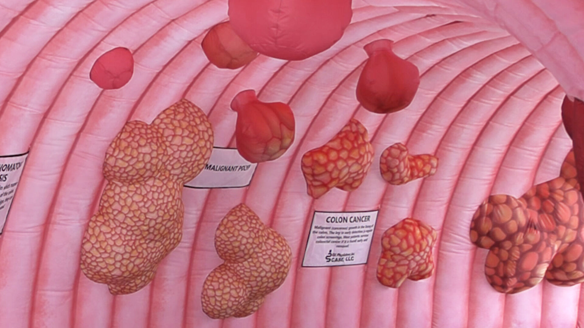 GI Physicians highlights the importance of Colonoscopies during Colorectal Cancer Awareness Month